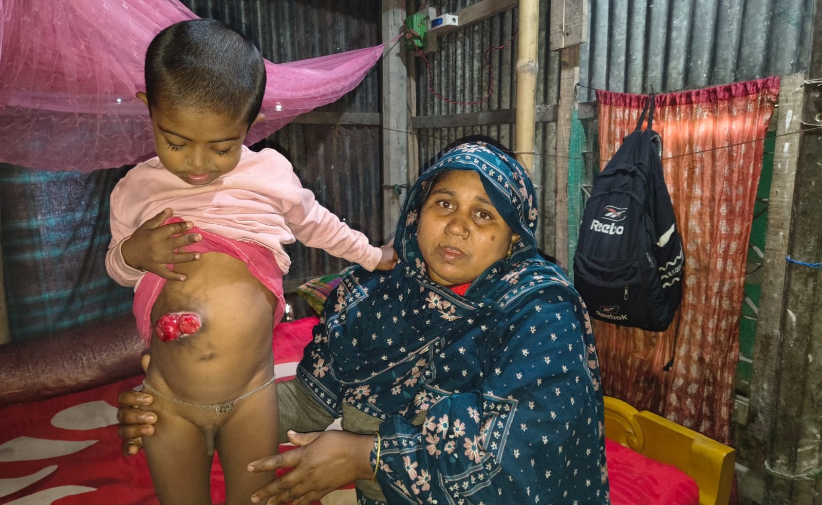 জন্ম থেকেই নেই পায়ুপথ, প্রতিটি নিঃশ্বাসে বাঁচার যুদ্ধ শিশু ওমরের