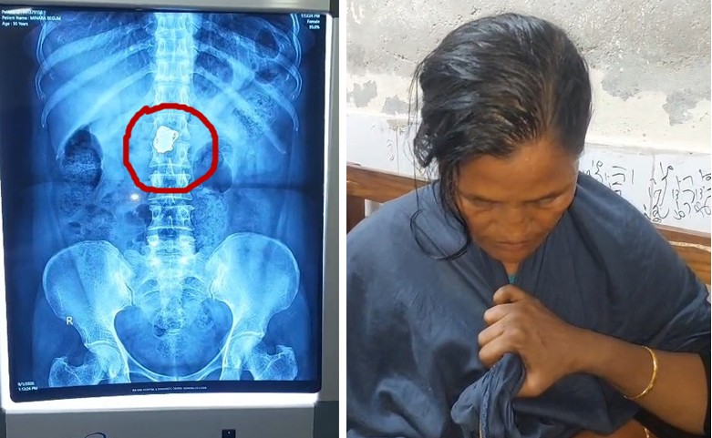 রোগী সেজে হাসপাতালে চুরি, এক্সরেতে পেটে মিলল দুই সোনার চেইন